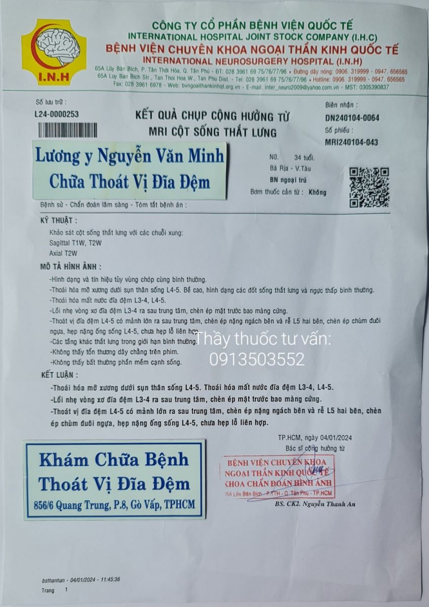 Cách trị thoát vị đĩa đệm L4 L5